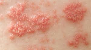 Kayap hanya akan berada dikawasan saraf bahagian dermatome sahaja. Diari Kaknis Pantang Larang Untuk Penyakit Kayap