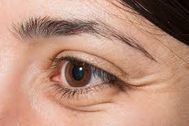 There are a number of home remedies to reduce puffy eyes from crying, from applying tea bags to making dietary changes. What Causes Puffy Eyes And How To Get Rid Of It