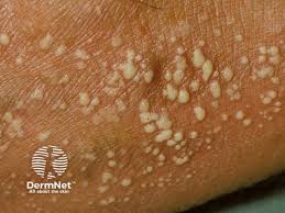 Image result for Pustular Psoriasis
