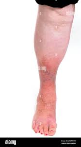 Image result for Lipodermatosclerosis