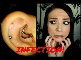 Daith Piercing Infection How I Cured It With Pictures Youtube