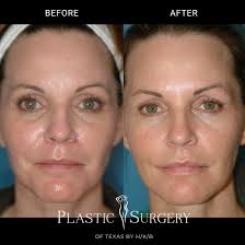 This patient received 5 vials of Sculptra over 3 months. The after photo is  6 months after the final treatment by #DrTittle. The advantages of long  term fillers are numerous! Cost over