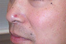 Image result for skin cancer on nose pimple
