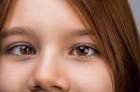 Image result for Strabismus