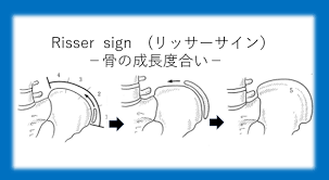 Image result for Risser Sign