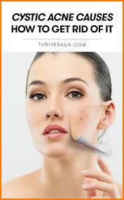 Cystic Acne Causes Treatments 5 Cystic Acne Home Remedies Thrivenaija Treating Cystic Acne Cystic Acne Acne Causes