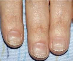 Beau S Lines Medicalopedia Lines On Nails Fingernail Health Fingernail Health Signs