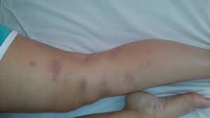 Фото, симптомы и лечение заболевания. Yazvennyj Kolit S Vnekishechnymi Proyavleniyami Klinicheskoe Nablyudenie Medicinskie Internet Konferencii