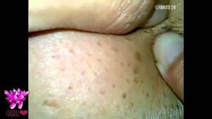 Ingrown hairs can be a huge torment for both women and men. Big Ingrown Hair Blackhead Popping Pimple Popping 2 Chun Flickr
