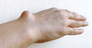 While bone pain is the main symptom of bone cancer, and pain in the hip bone can be an indication of a tumor in the hip, there are often more likely other explanations for hip pain. Types Of Bone Tumors Symptoms Treatment Omni Hospitals Omni Hospitals