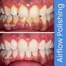 Hoghton Street Dental | Airflow Polishing Dental Hygiene Southport