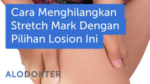 Faktor lain yang sering menyebabkan munculnya stretch mark adalah kehamilan. Cara Menghilangkan Stretch Mark Dengan Pilihan Losion Ini Youtube