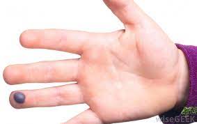 Mar 28, 2017 · dr. What Causes Blood Blisters With Pictures
