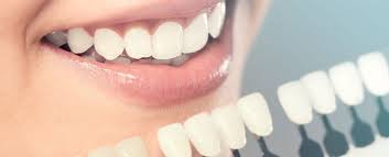 Top 5 Cosmetic Dental Procedures for a Perfect Smile