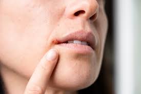 Image result for Lip Cancer
