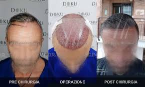 In questo caso, applicare del ghiaccio . Galleria Trapianto Capelli Turchia