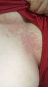 Image result for heat rash under breasts