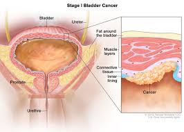 Symptoms include blood in the urine, pain with urination, and low back pain. Bladder Cancer Medlineplus Genetics