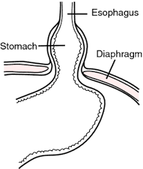 Sliding Hernia Definition Of Sliding Hernia By Medical Dictionary Medical Dictionary Medical Terms Umbilical Hernia