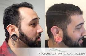 Pin On Photos From Natural Transplants Hair Restoration Clinic