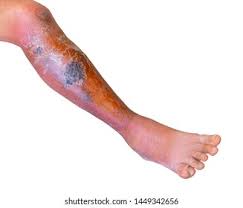 Image result for erysipel photos)