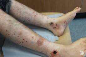 Image result for Vasculitis