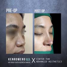 Feminine Structural Goretex Rhinoplasty 💅 #asianrhinoplasty  #beforeandafterrhinoplasty #StructuralRhinoplasty Dr. Ken Romero's Services  SURGICAL • Structural Rhinoplasty (Goretex, mesh, and cartilage) •  Blepharoplasty • Otoplasty • Buccal Fat Removal ...