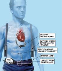 When placed in the left ventricle it is called a left ventricular assist device (lvad). How To Manage Emergency Department Patients With Left Ventricular Assist Devices Acep Now
