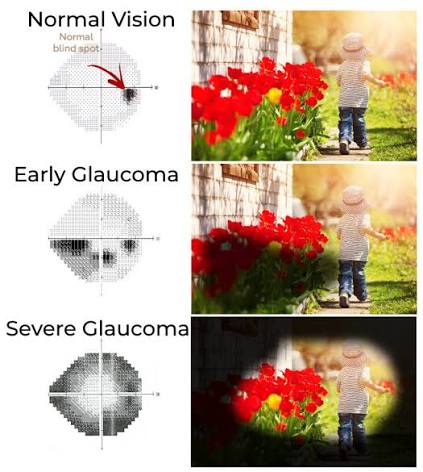 Glaucoma | Anderson & Shapiro Eye Surgeons