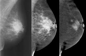 Kontrastmittel Mammographie Ein Plan B Fur Die Mrt Healthcare In Europe Com