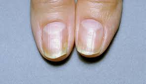 It could mean something critical to your health. What Are Your Nails Saying About Your Health