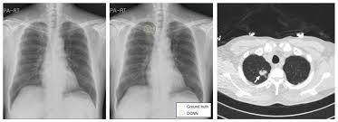 Image result for lung cancer xray