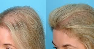 как ускорить рост волос на голове в домашних условиях Eto Ochen Prostaya I Effektivnaya Maska Gotovit Ee Elementarno Ingredienty Lavrovyj List 4 5 Shtu Stop Hair Loss Hair Regrowth Treatments Hair Loss Remedies