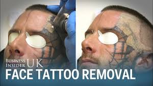 Laser removal is one of the most standard methods of tattoo removal, but it can cause. Watch This Man Have His Face Tattoo Removed From Laser Surgery Youtube