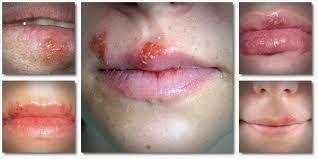 Cold sores sometimes called fever blisters, are groups of small blisters on the lip and around the mouth. How To Treat Cold Sores Fast Get Rid Of Cold Sores Fast Teaches People Effective Tips To Get Rid Of Cold Stores Vkoolelite