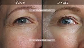 The thickness of the epidermis increased substantially more after treatment with 0.05 percent tretinoin or 0.01 percent tretinoin than after treatment with placebo. Hotandflashy Com Bloglovin Botox Fillers Anti Aging Face Cream Anti Aging