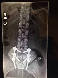 Spinal Fusion Rockin The Hardware Spinal Fusion Spinal Fusion Surgery Back Surgery