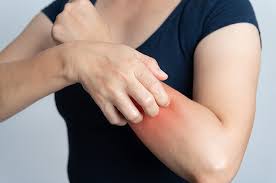 Nyatanya, diabetes tipe 2 termasuk salah satu penyakit yang cukup kronis. 3 Cara Mengatasi Gatal Kulit Pada Pengidap Diabetes