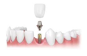 Common Dental Implant Questions Answers Manhattan Ny