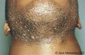 So, what you should do is go with the flow. Pseudofolliculitis Barbae American Osteopathic College Of Dermatology Aocd