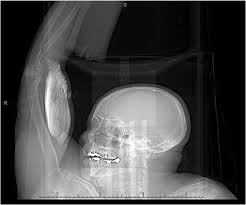 Image result for CT Intravenous Contrast