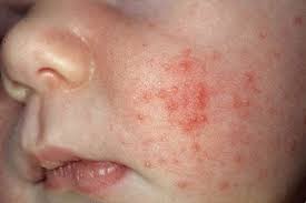 Semua ibubapa nak bayi sentiasa sentiasa selesa kan. Jangan Abaikan Ruam Pada Wajah Anda Bisa Jadi Itu Gejala Penyakit Berat Apa Saja Erabaru Kesehatan Bayi Jerawat Kulit