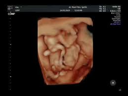 Calon bayi irish dan ammar zoni meninggal dunia di dalam kandungan yang menginjak usia 27 minggu. Gemesin Janin Kembar 13 Mgg Youtube