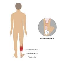 Wie wird der achillessehnenriss diagnostiziert? Achillessehnenruptur Achillessehnenriss Deutsche Gesellschaft Fur Unfallchirurgie