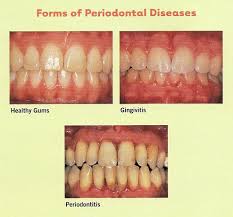 Image result for Periodontitis