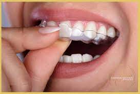 Saiba mais sobre os preço do invisalign e conheça mais sobre o tratamento com o alinhador mais avançado do mundo. Quanto Custa O Invisalign Dra Juliana Mattos Valor Especial Para Itau