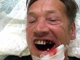 Owen and jayson face a harsh penalty for their lockdown prank. Eastenders Sid Owen Shows Off Horrific Injuries After Golfball Shattered Jaw In Freak Accident And He Almost Died Ok Magazine