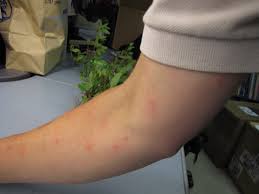 Identifying 21 Common Red Spots On Skin Universal Dermatology