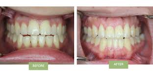 The average invisalign treatment takes between 12 and 18 months. Invisalign For Open Bite Does Invisalign Work For Open Bites