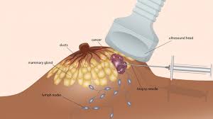 This test will usually help determine that the nodule has a low chance of being cancerous (has characteristics of a benign nodule), or that it has some characteristics of a cancerous nodule, and therefore a biopsy is indicated. Ultrasound Scans Irish Cancer Society